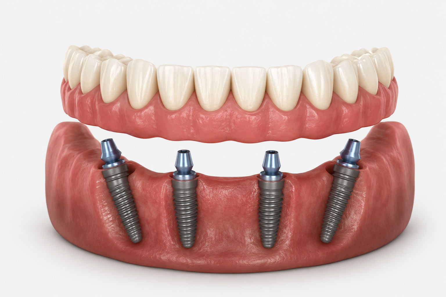 Illustration of All-on-4 full-arch dental implants.